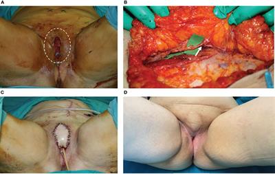 Secondary post-oncologic vulvar reconstruction – a simplified algorithm